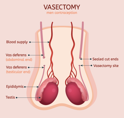 Vasectomy Expectations and Effectiveness menMD