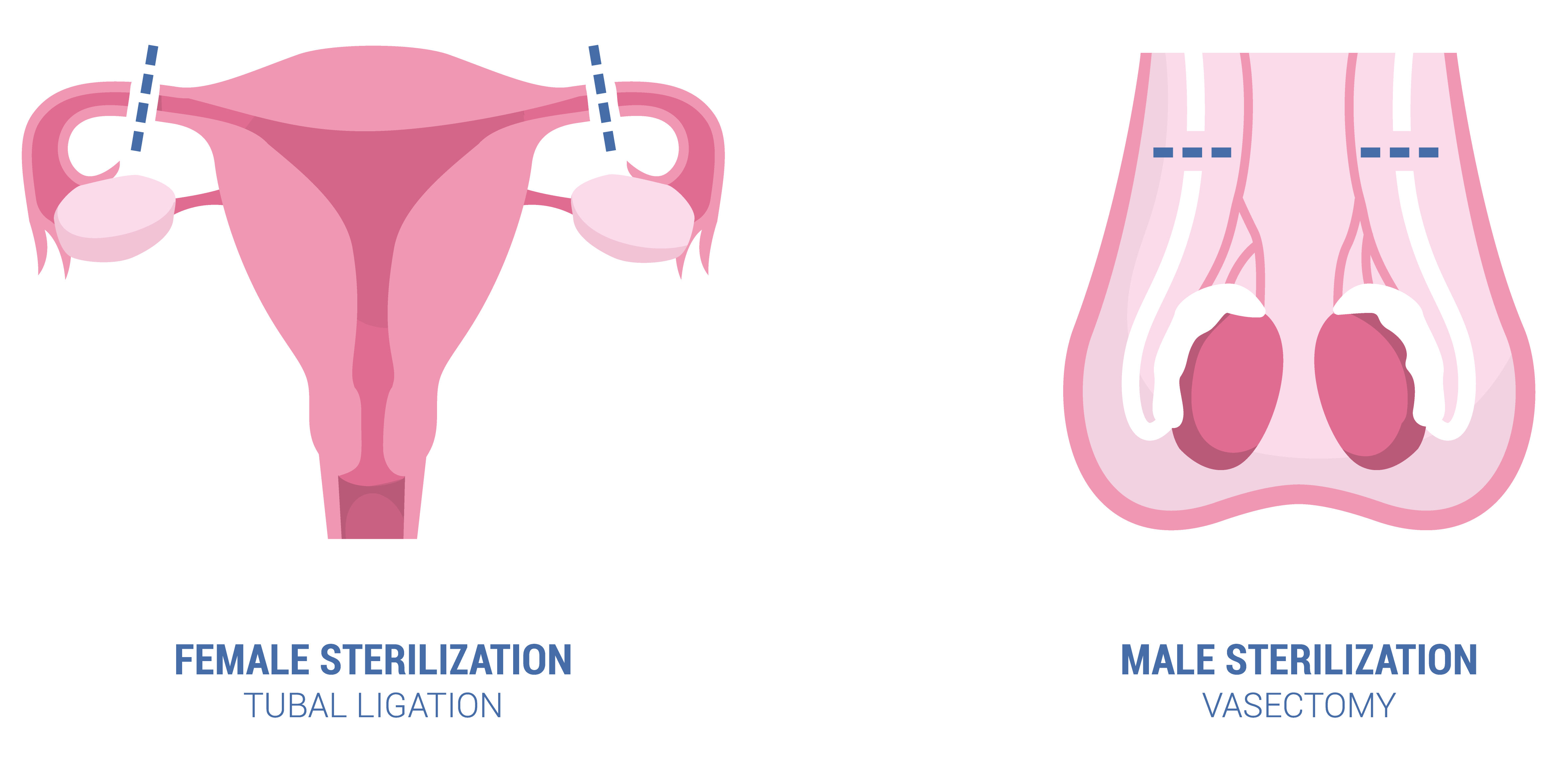 Vasectomy: Procedure, Recovery & Effectiveness