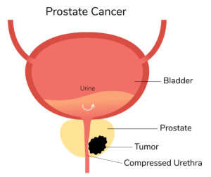 Radical Prostatectomy