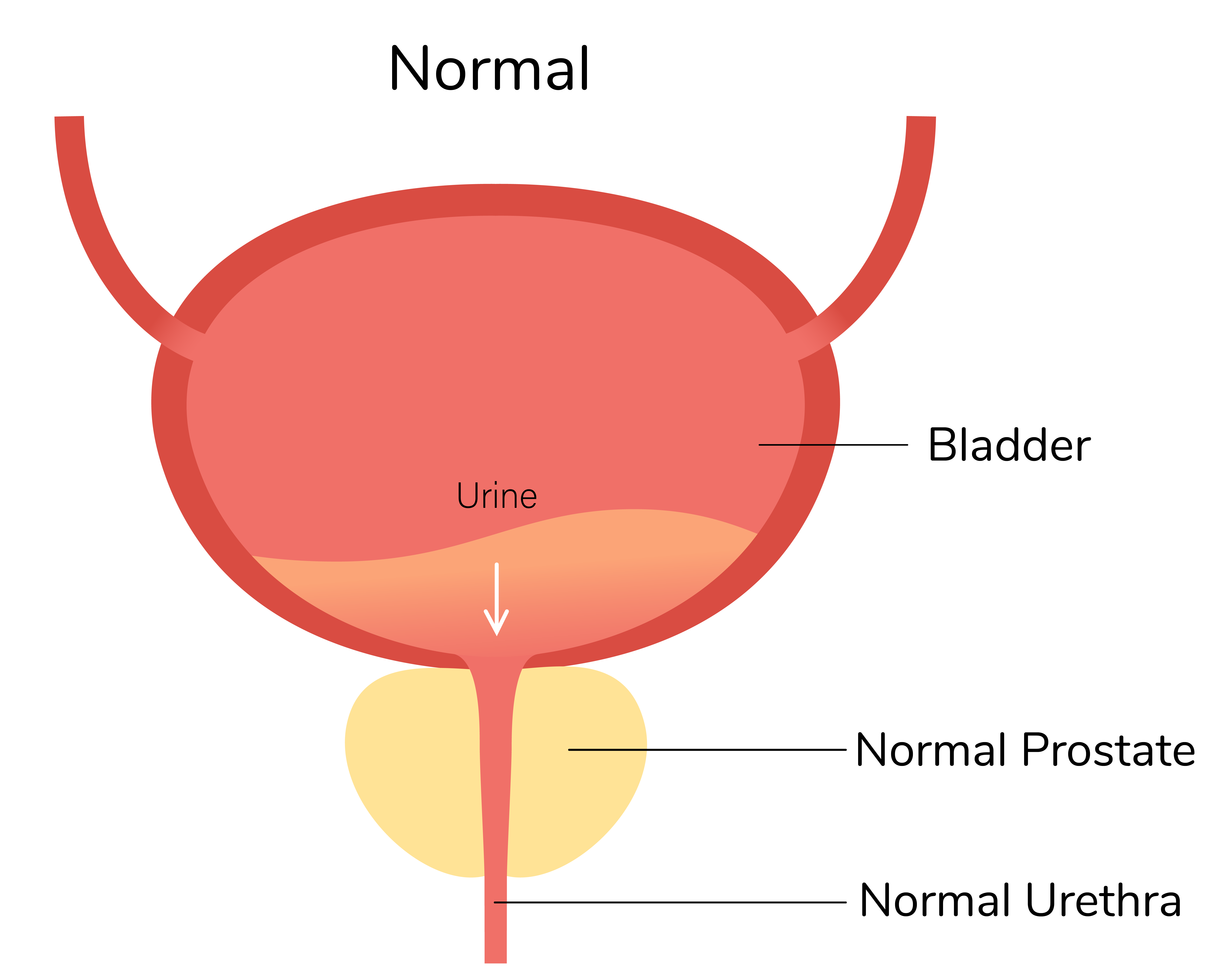 How An Enlarged Prostate Affects Your Sexual Health menMD