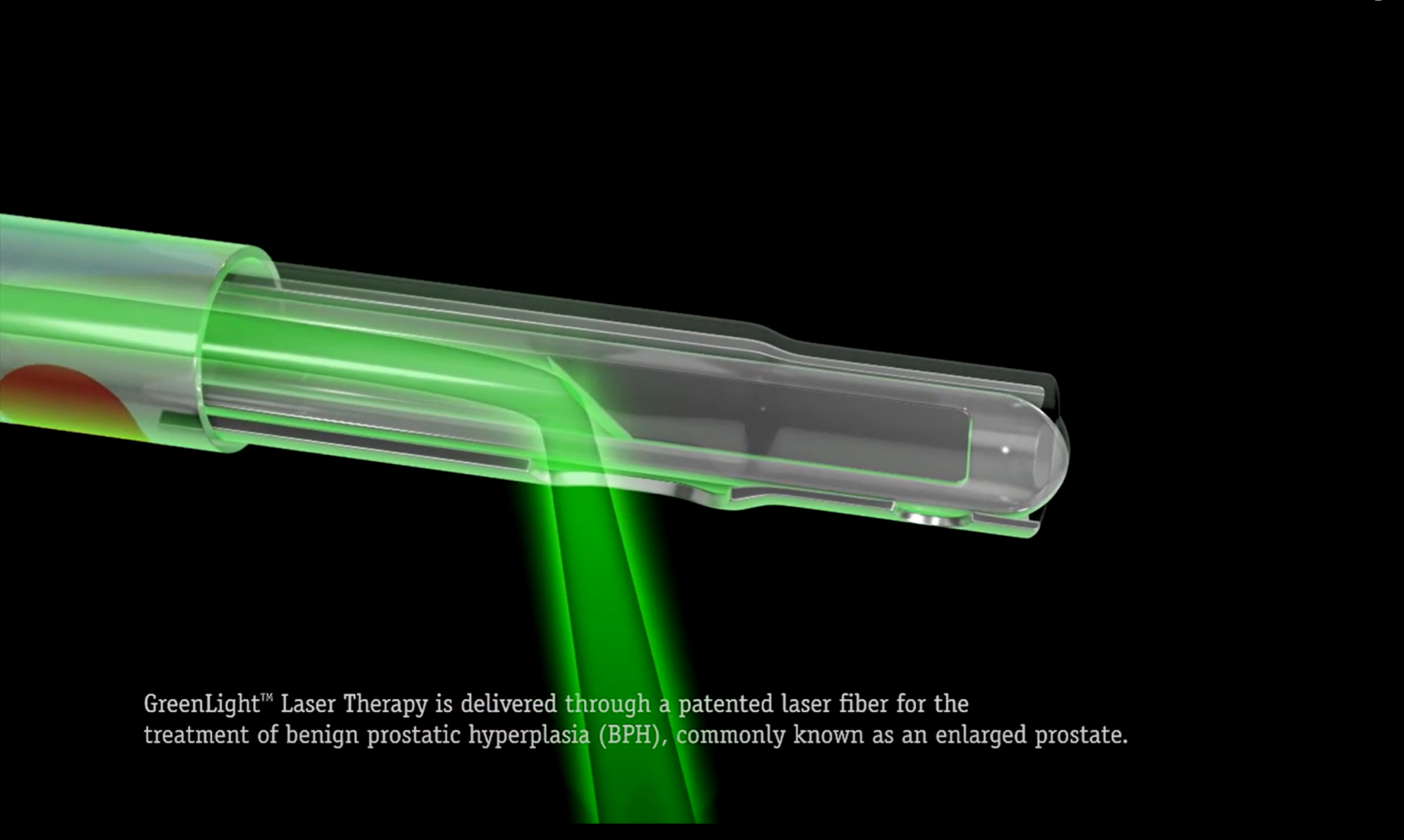 Boston Scientific GreenLight™ Laser Therapy menMD